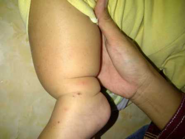 2 Balita Terjangkit Gatal-Gatal, di Duga Akibat Debu Besi PT. KS Posco