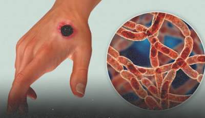 Ilustrasi dari bakteri yang menyebabkan Anthrax pada tubuh manusia. (Foto: Kateryna Kon/Shuttestock.com)